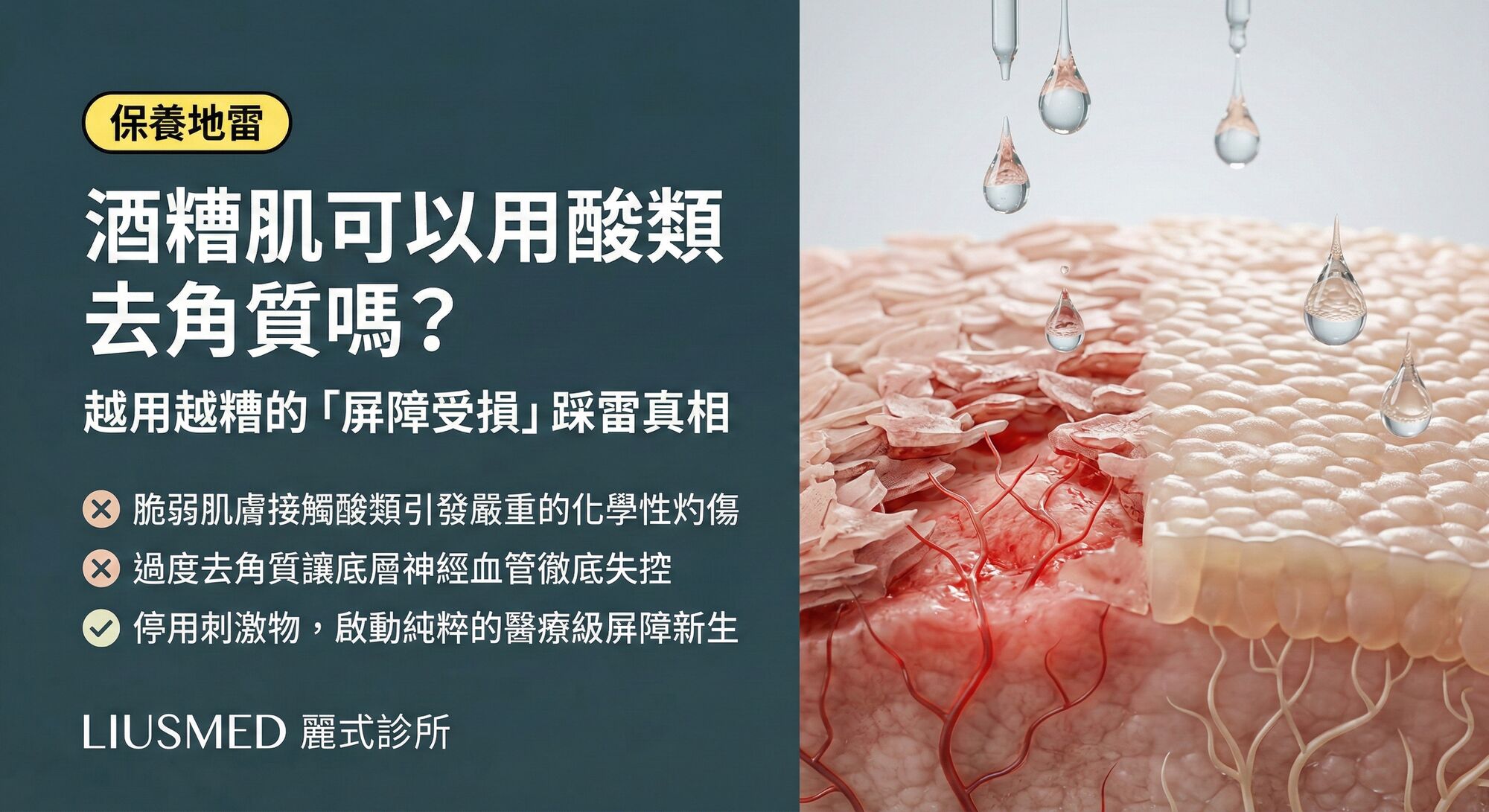 酒糟肌可以用酸類保養或去角質嗎?越用越糟的「屏障受損」地雷