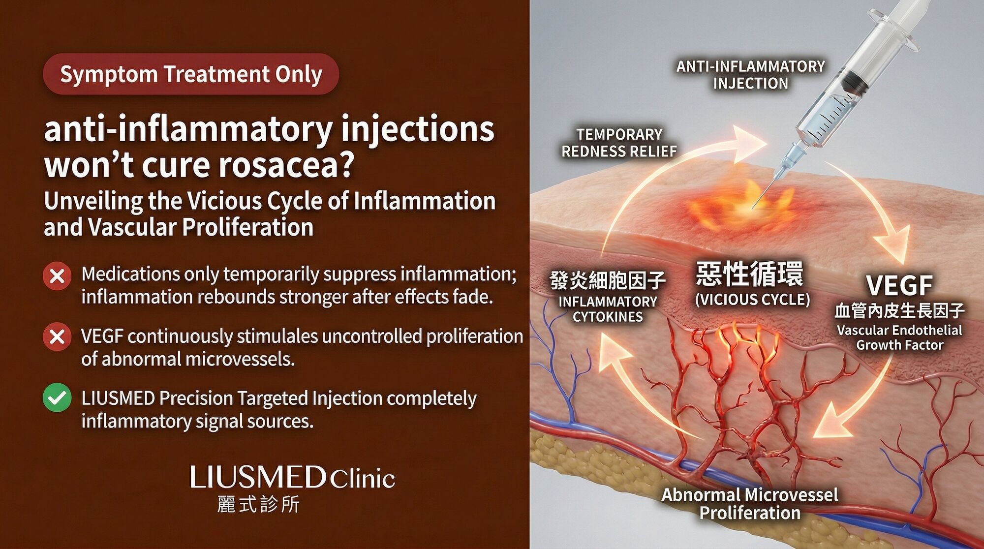 Anti-Inflammatory Injections Can't Cure Rosacea? The Vicious Cycle of Inflammation and Angiogenesis