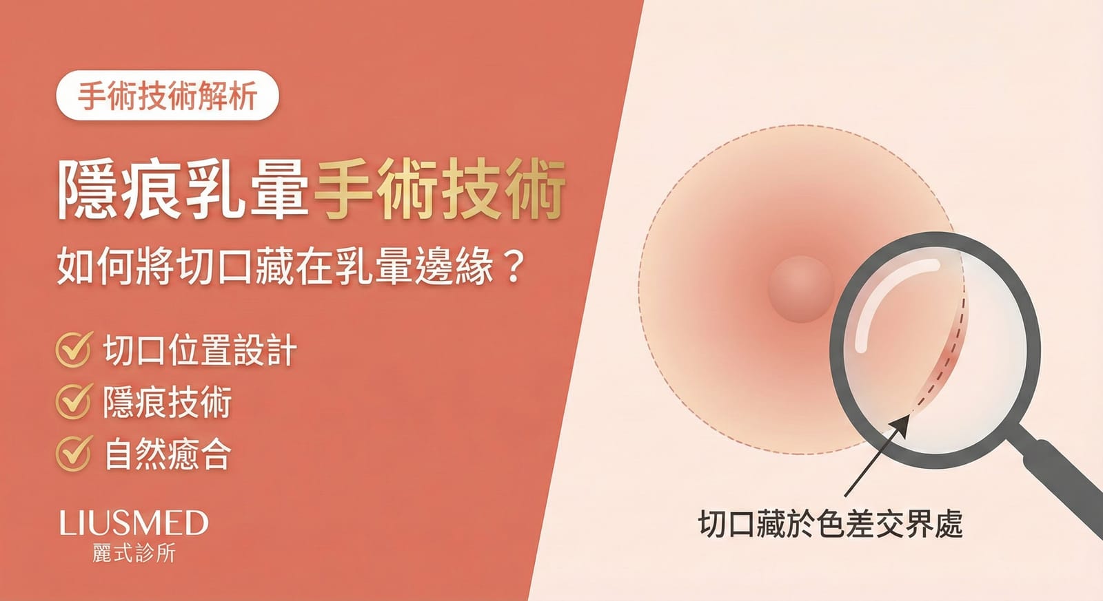 隱痕乳暈手術：如何將切口藏在乳暈邊緣？