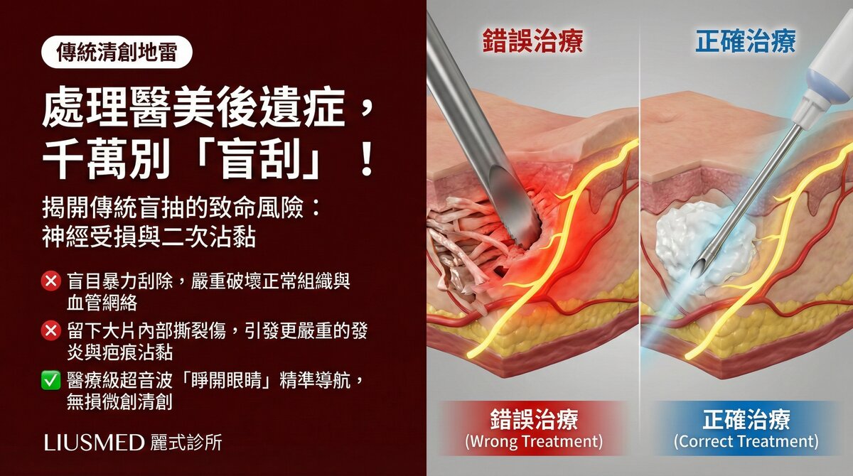 為什麼處理醫美併發症絕對不能「盲抽/盲刮」?傳統清創的致命盲點