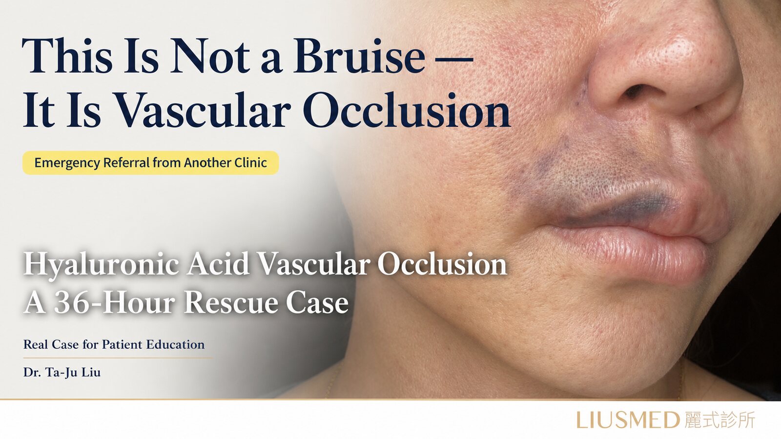 36-Hour HA Filler Vascular Embolism Rescue (Full Case at FILLER REVISION)