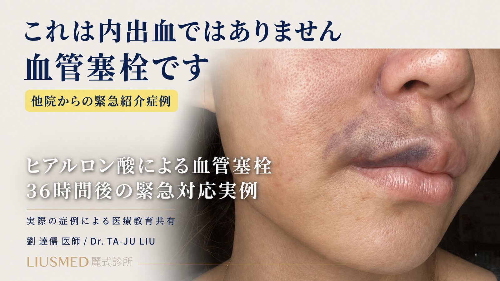 ヒアルロン酸塞栓 36 時間救命（完全症例は FILLER REVISION 修復専門サイトへ）