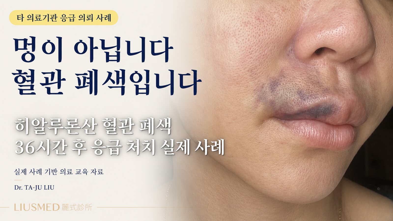 HA 필러 혈관 색전 36시간 구조 (전체 증례는 FILLER REVISION 수복 전문 사이트에)