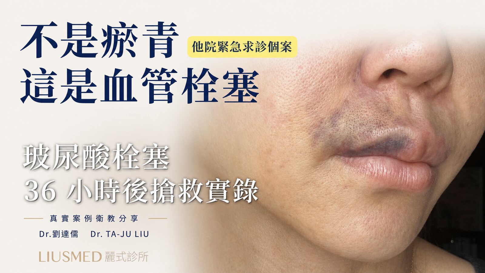 玻尿酸栓塞 36 小時搶救（完整案例請見 FILLER REVISION 修復專科站）