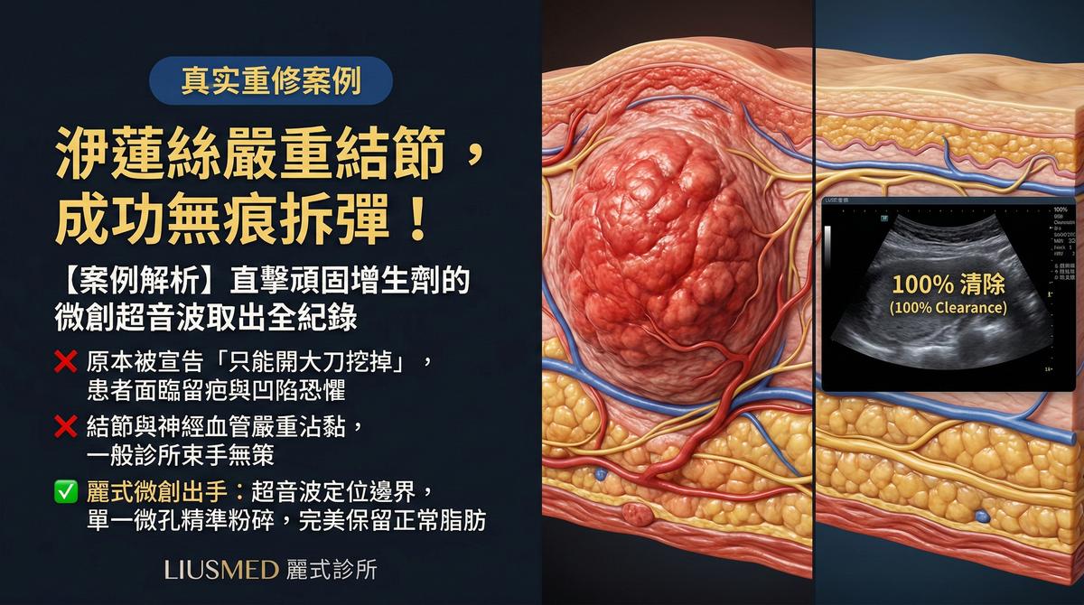 【案例解析】洢蓮絲嚴重結節，微創超音波導引取出全紀錄（去識別化衛教）