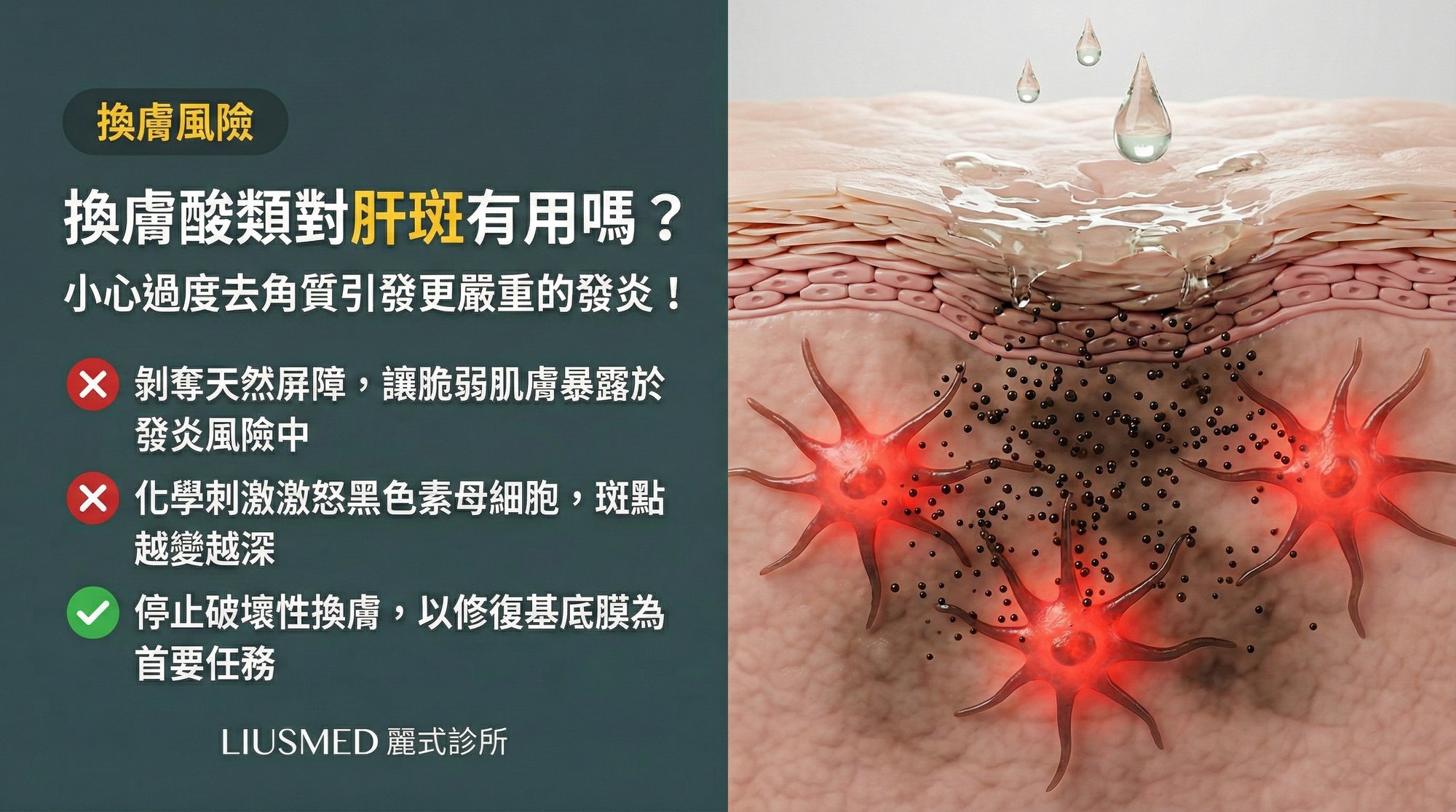換膚酸類保養品對肝斑有用嗎?小心過度去角質引發更嚴重的發炎