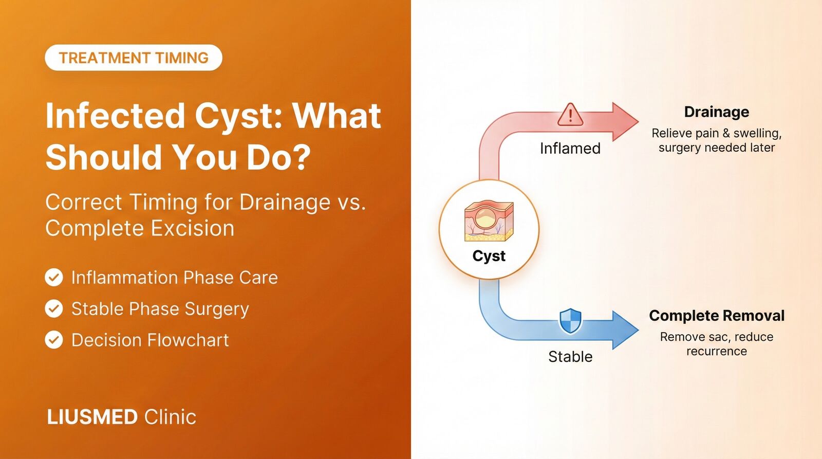 感染した粉瘤：ドレナージか完全摘出か — 治療のタイミング