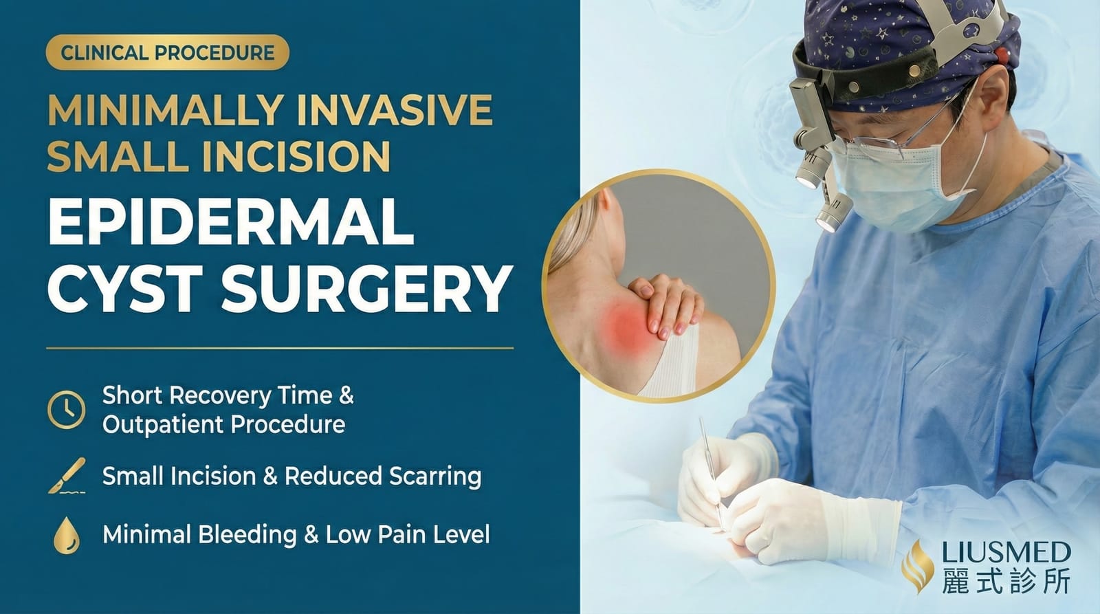 Epidermal Cyst Complete Guide: Causes, Symptoms & Minimally Invasive Treatment