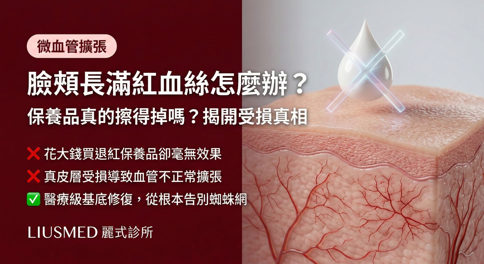 臉頰長出一條條紅血絲(微血管擴張)怎麼辦?保養品真的擦得掉嗎?