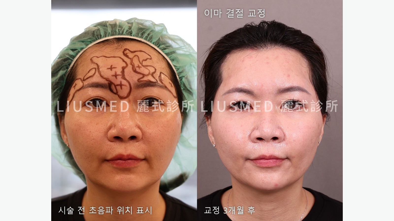 2년 된 이마 엘란쎄 결절, 히알루로니다제도 세척도 소용없던 증례: 초음파 지도에서 교정 3개월 후까지