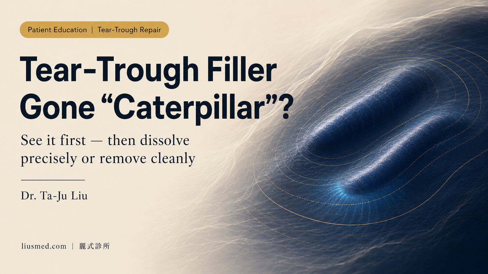 Why Tear-Trough Filler Turns Into 'Caterpillars' — How to Avoid It, and How to Fix It