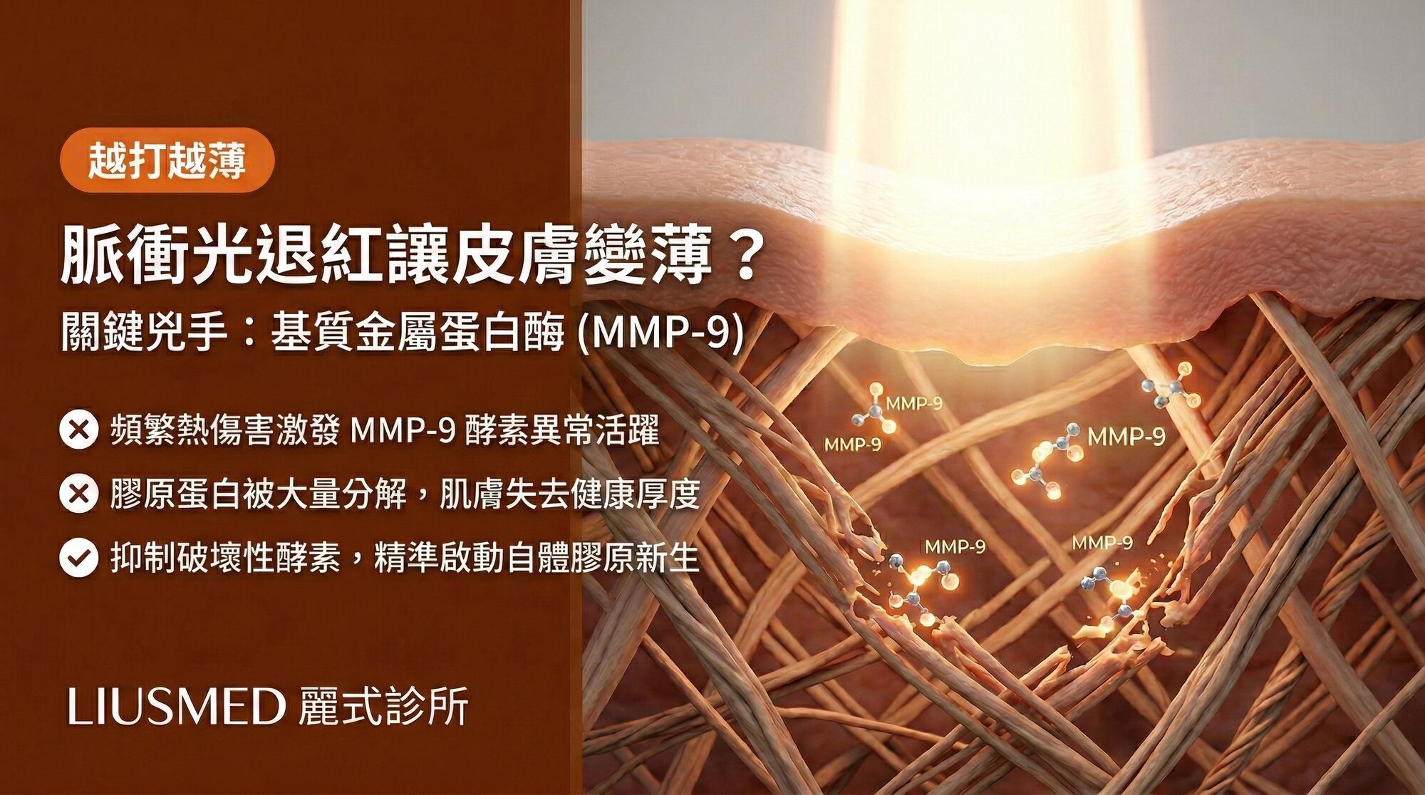 脈衝光 (IPL) 退紅卻讓皮膚變乾變薄?基質金屬蛋白酶 (MMP-9) 才是關鍵