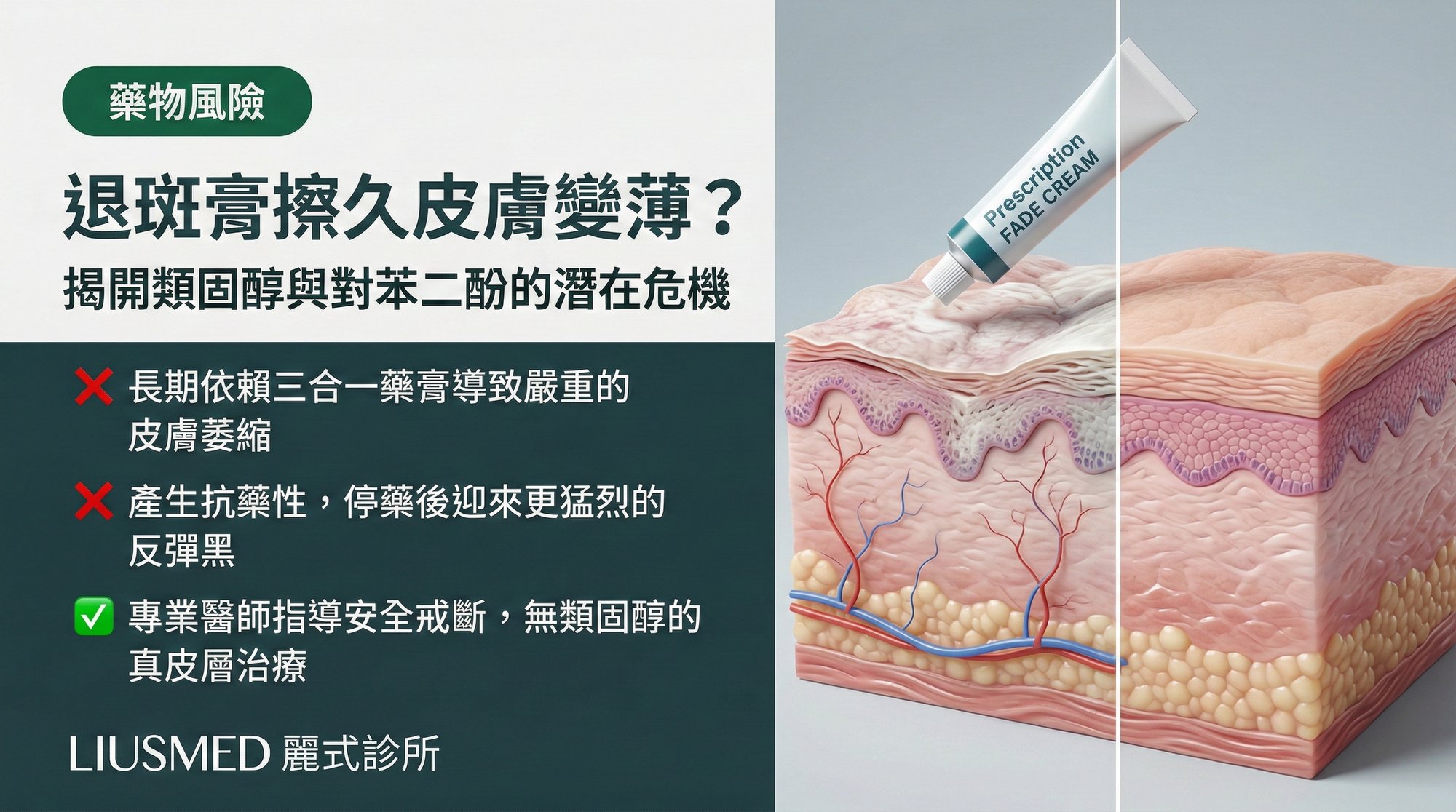 三合一退斑膏 (Kligman's) 擦久了皮膚變薄?類固醇與對苯二酚的潛在風險