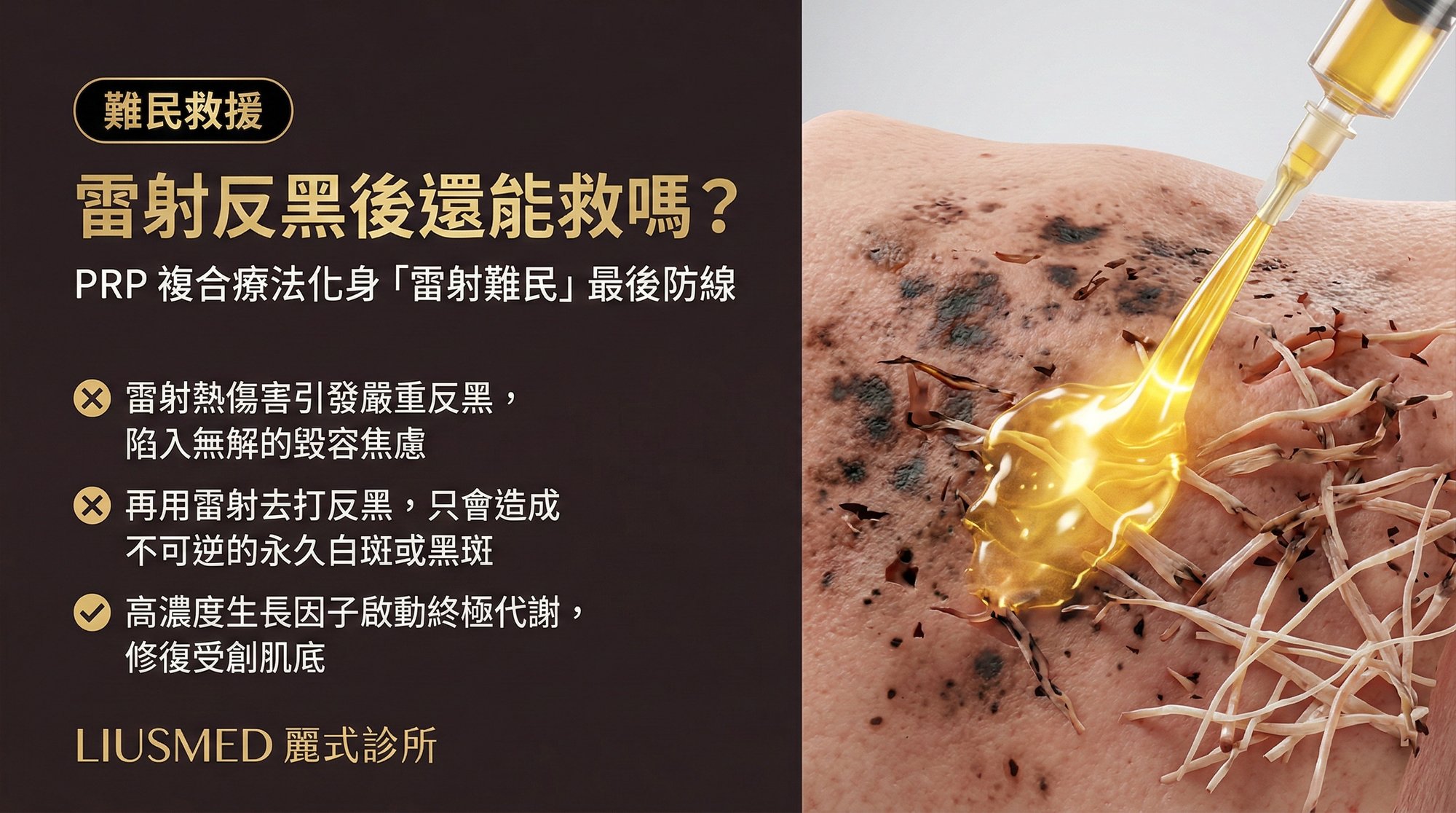 雷射反黑後還能救嗎?PRP 複合療法如何成為「雷射難民」的最後防線