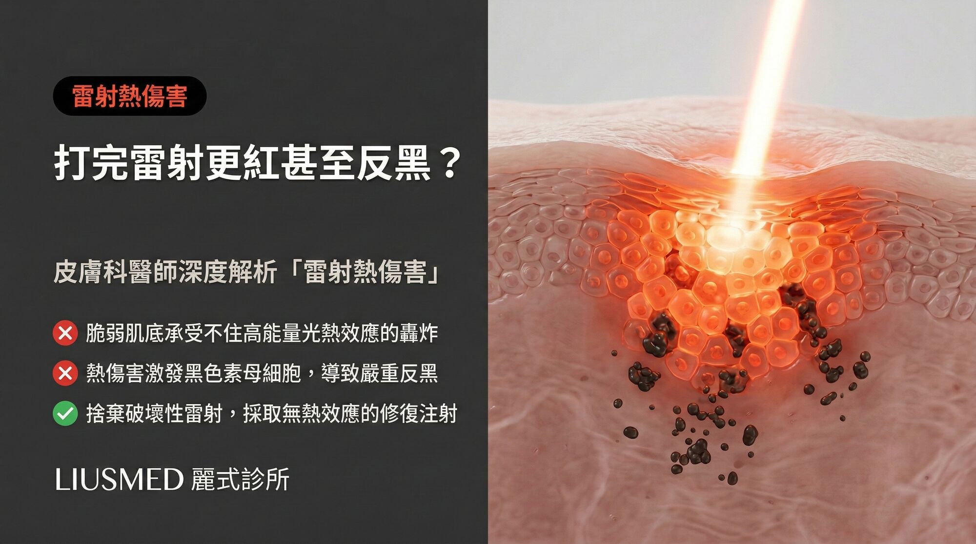 打完雷射臉更紅、更敏感甚至反黑?皮膚科醫師解析「雷射熱傷害」