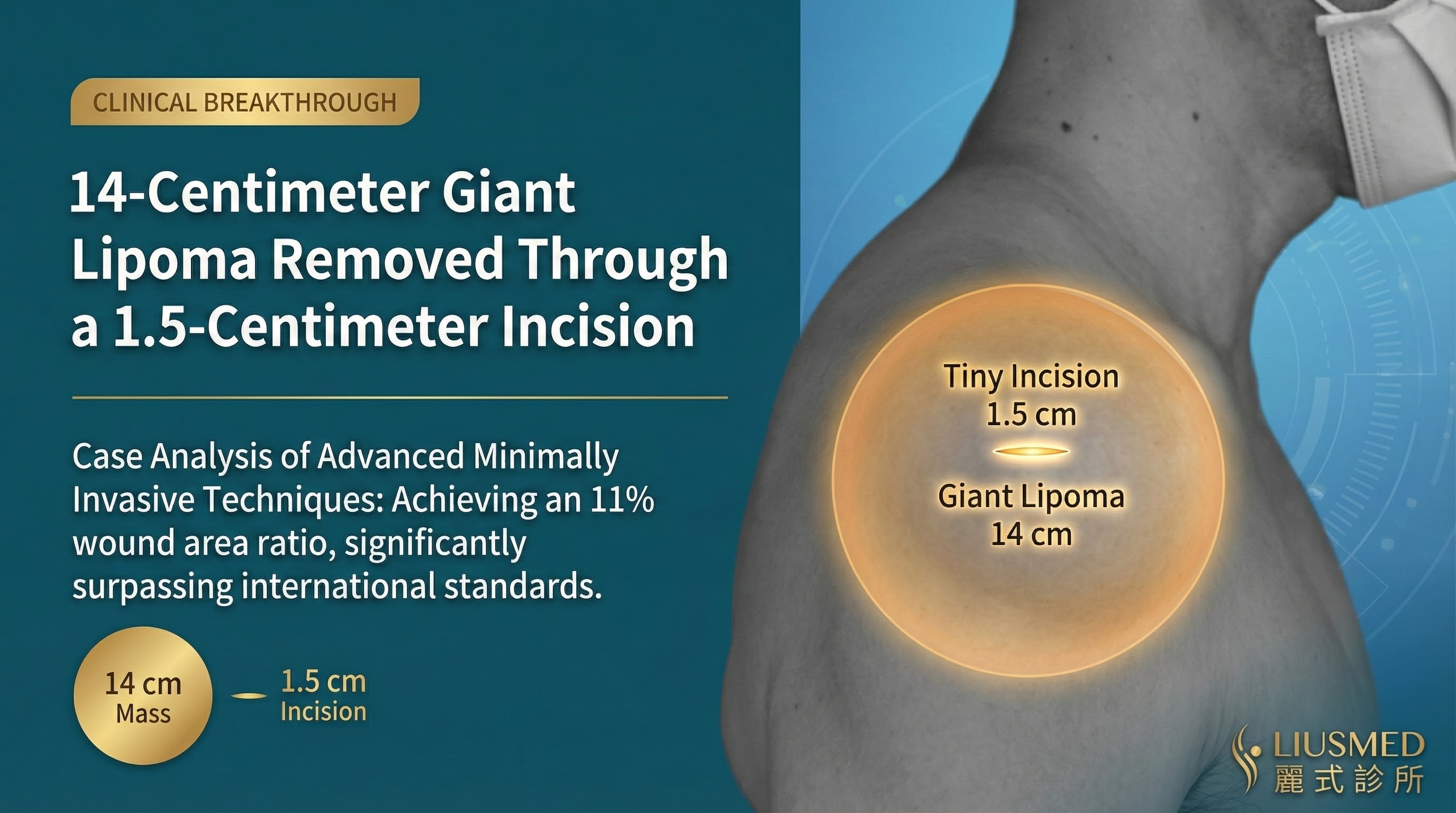 14cm Giant Lipoma Removed Through 1.5cm Incision: Minimally Invasive Case Study