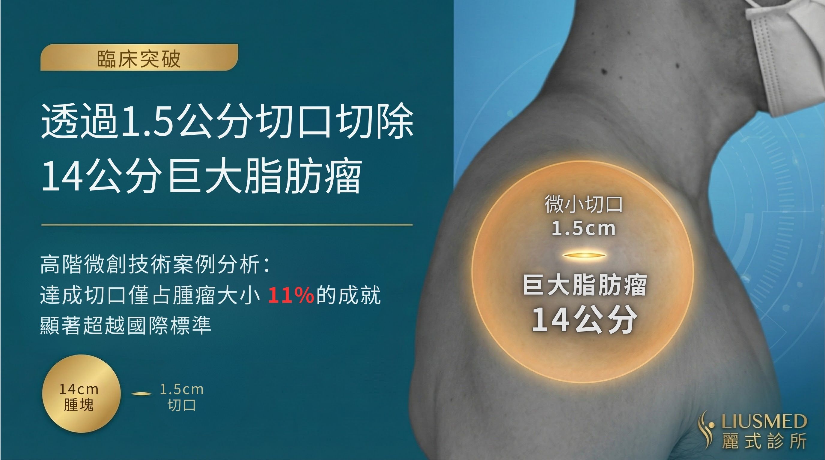 14公分巨大脂肪瘤僅1.5公分傷口：精研微創技術案例分析