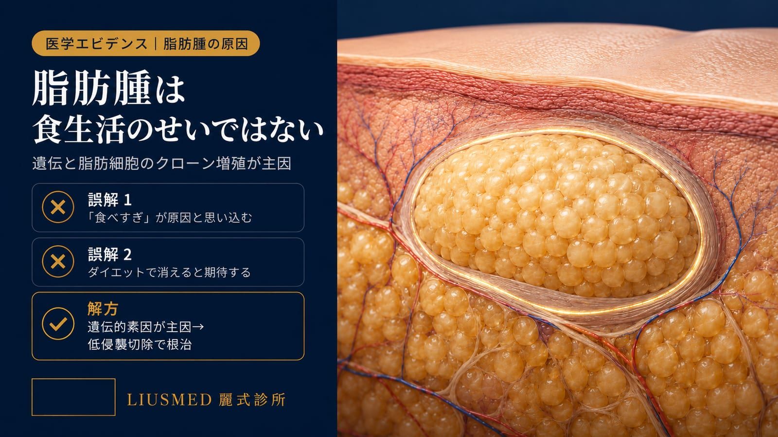 脂肪腫はなぜできるの？成因・好発年齢・リスク因子を徹底解説