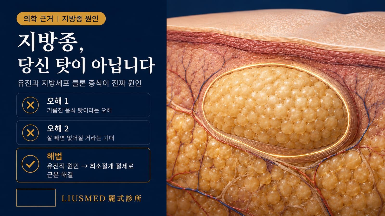 지방종은 왜 생기나요? 원인·호발 연령·위험 인자 완전 정리