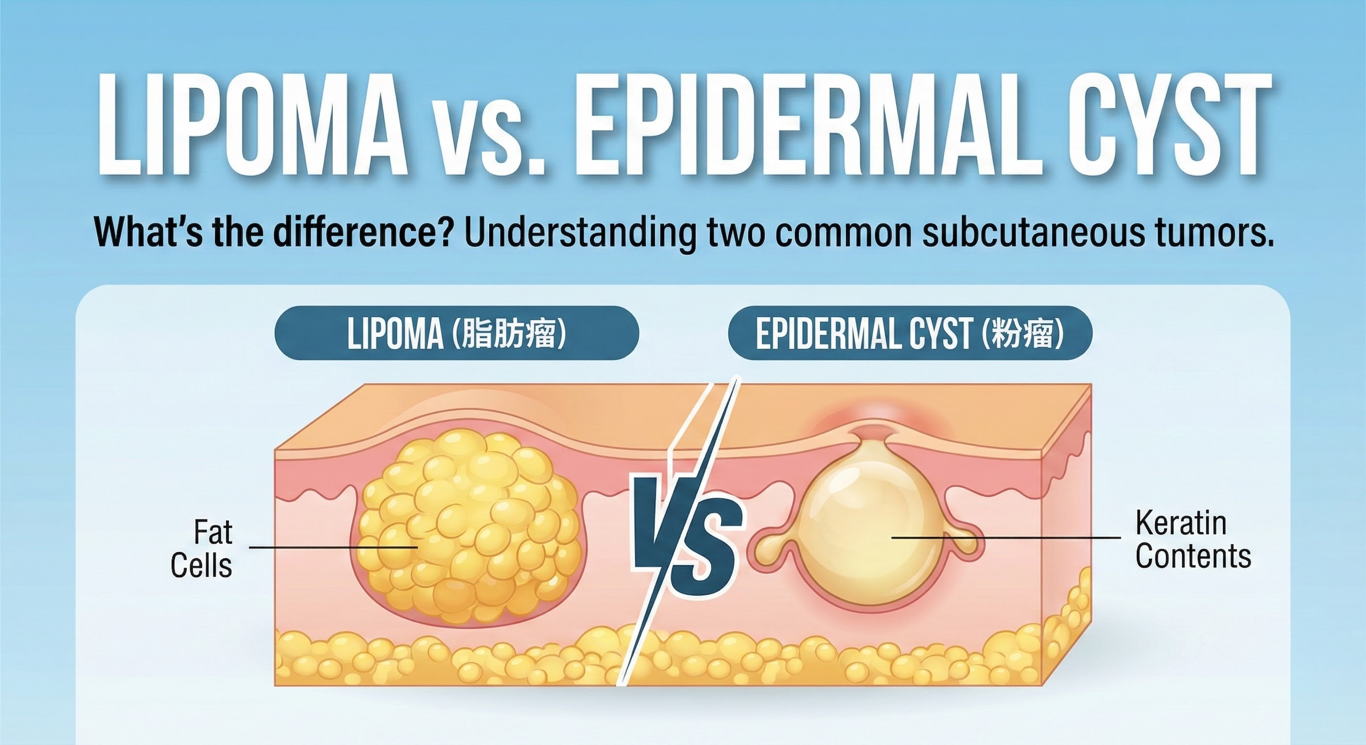 Lipoma vs Epidermal Cyst: Understanding the Difference Between These Common Subcutaneous Tumors