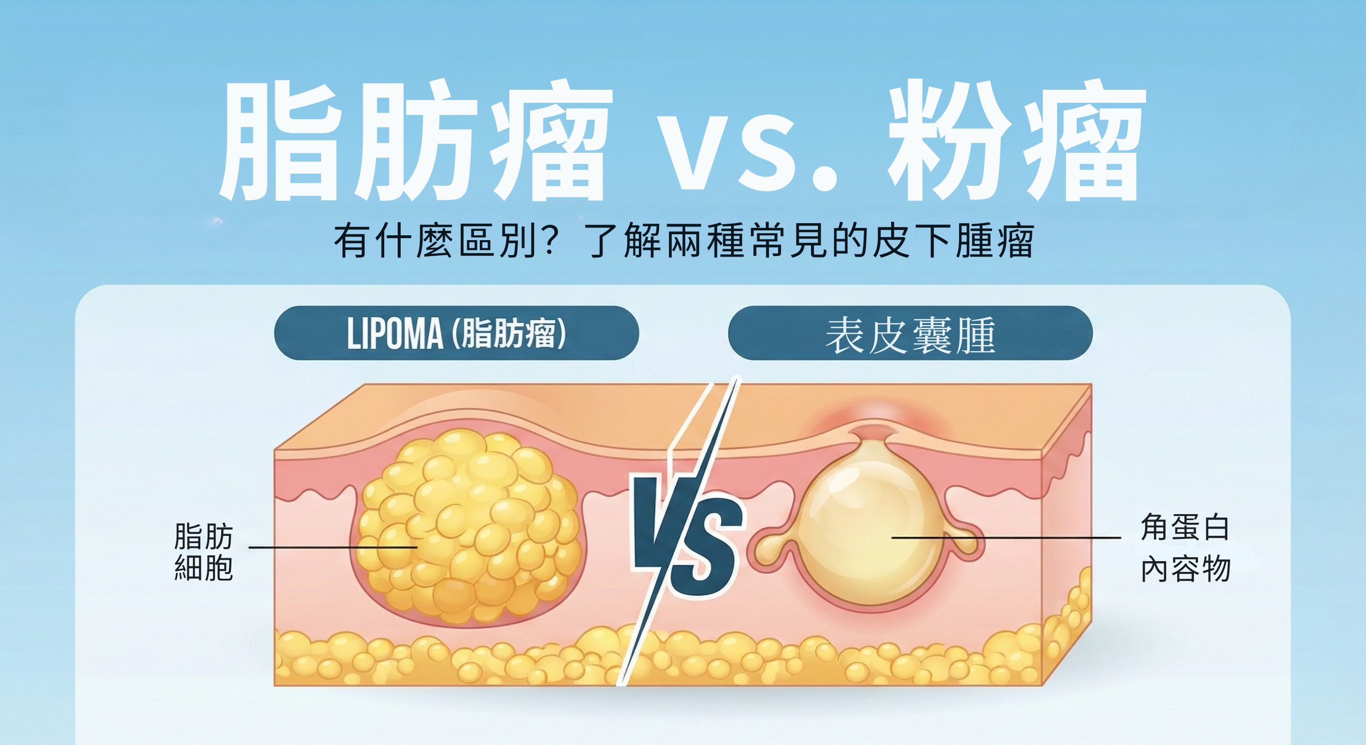 脂肪瘤和粉瘤有什麼不同？一次搞懂兩種常見皮下腫瘤