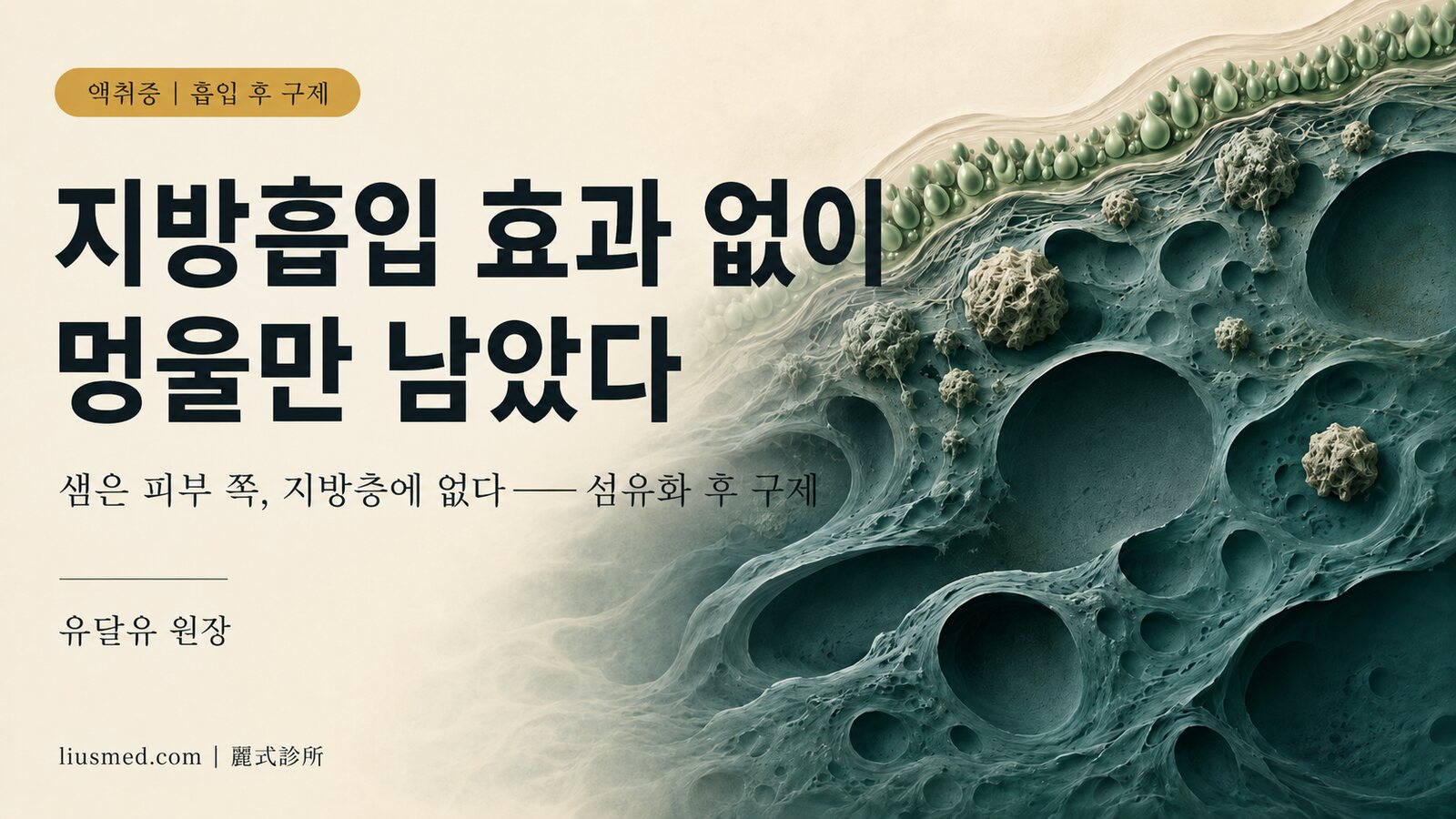 지방흡입으로 액취증을 치료했는데 냄새가 그대로고 멍울이 남았다? 흡입 후 섬유화된 겨드랑이의 구제 수술