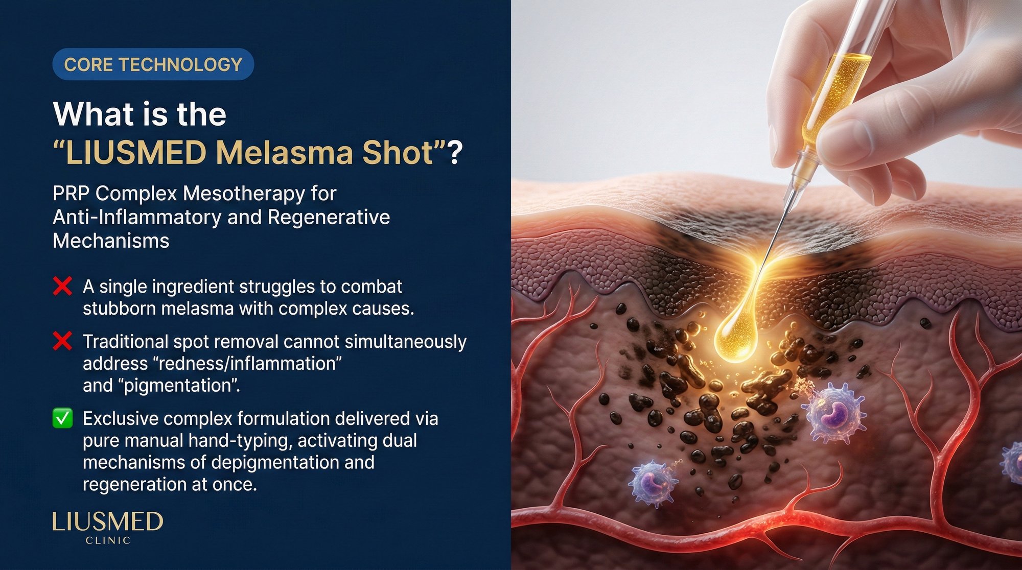 What Is the Liusmed Melasma Injection? The Anti-Inflammatory and Regenerative Mechanism of PRP-Enhanced Manual Mesotherapy
