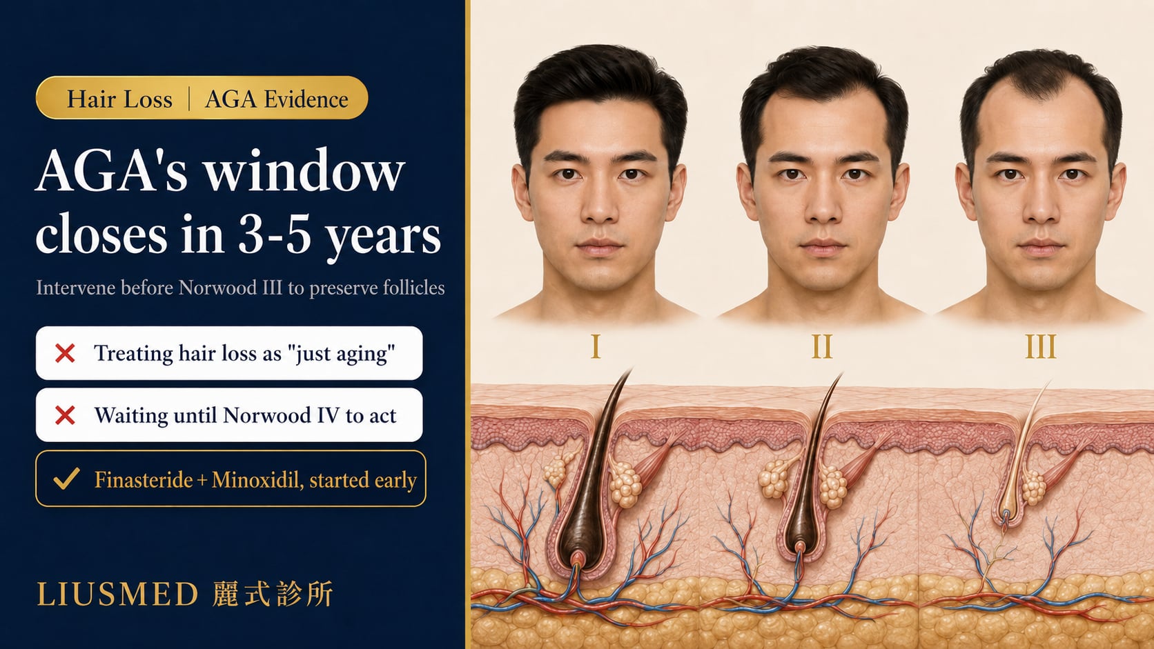 Male AGA Early Intervention Guide: Norwood Staging, Treatment Timing, and Therapy Selection (2026 Evidence-Based)