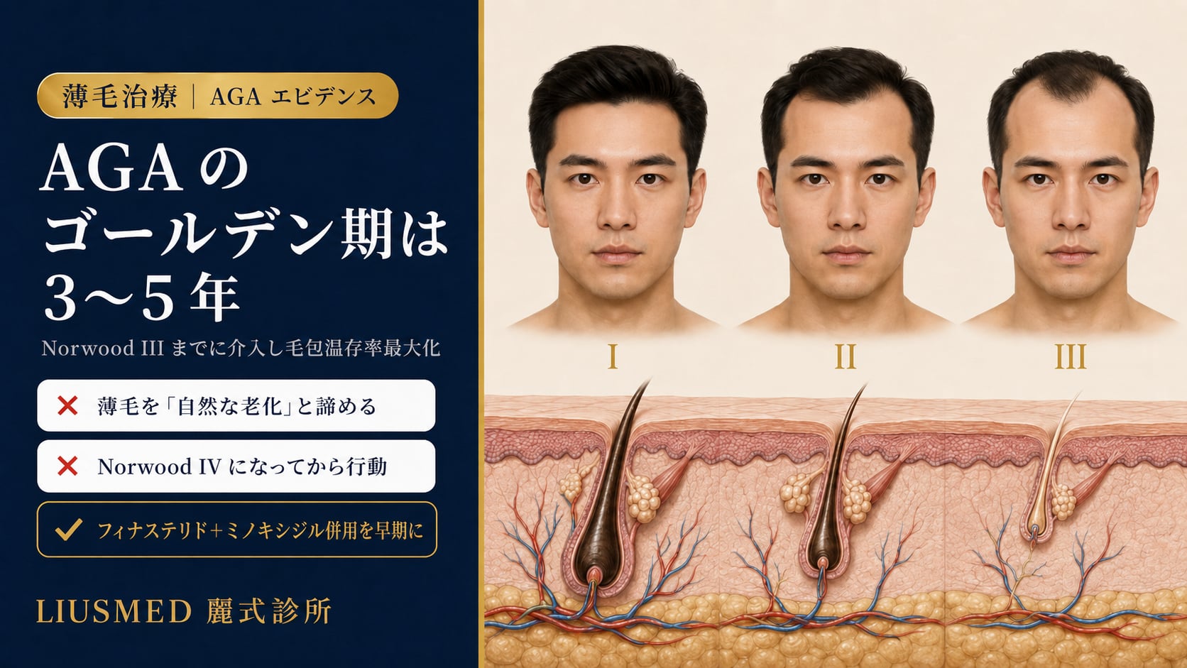 男性 AGA 早期介入完全ガイド：Norwood 分類・治療開始時期・薬物と療法選択（2026 エビデンス）