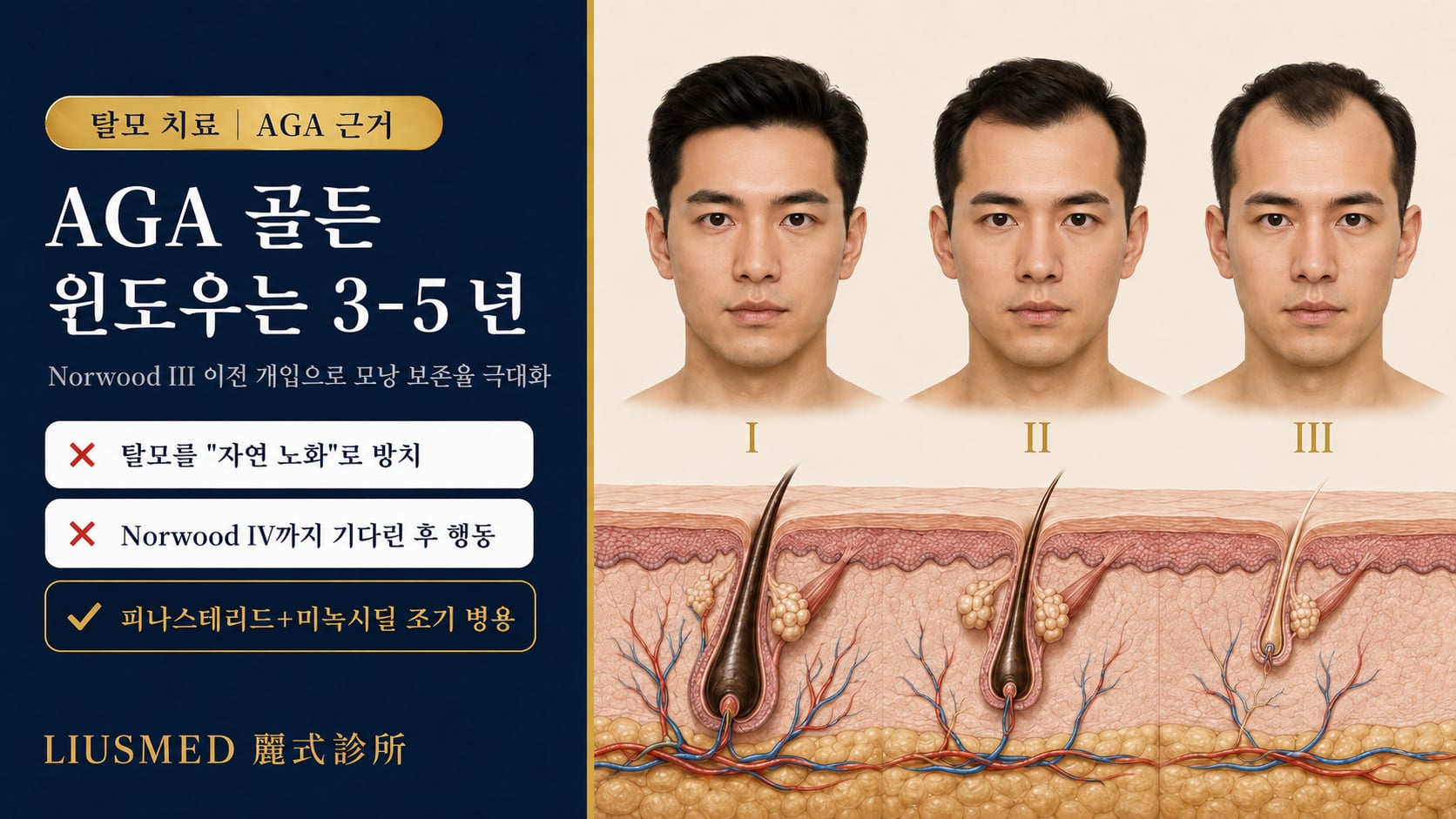 남성 AGA 조기 개입 완벽 가이드: Norwood 분류, 치료 시작 시기, 약물과 요법 선택(2026 근거)