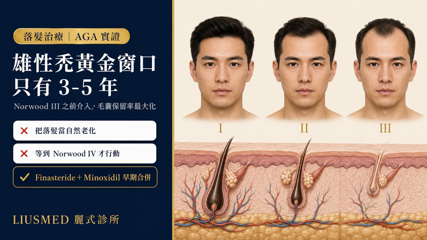 男性雄性禿早期介入完整指南：Norwood 分級、何時開始治療、藥物與療法選擇（2026 實證）