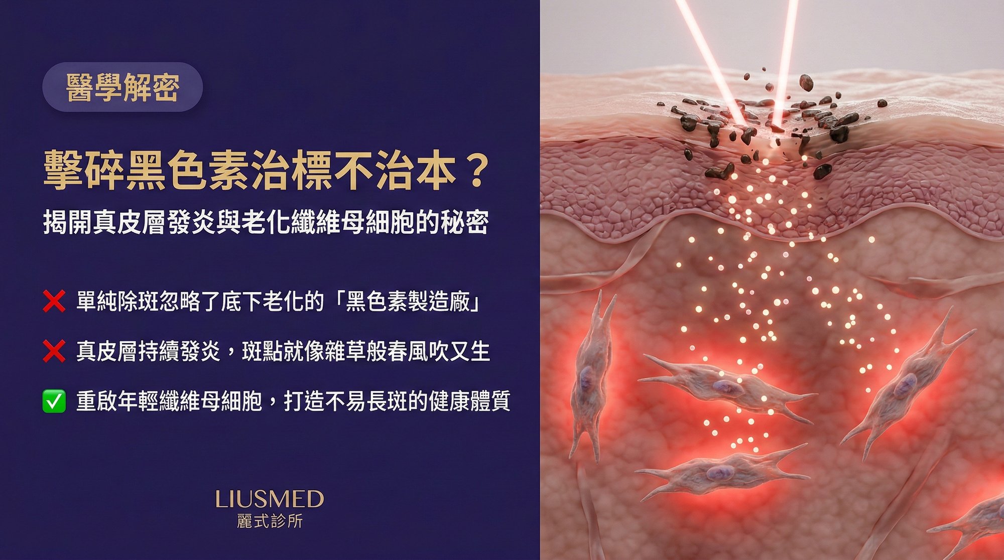 為什麼單純「擊碎黑色素」治標不治本?揭開真皮層發炎與老化纖維母細胞的秘密