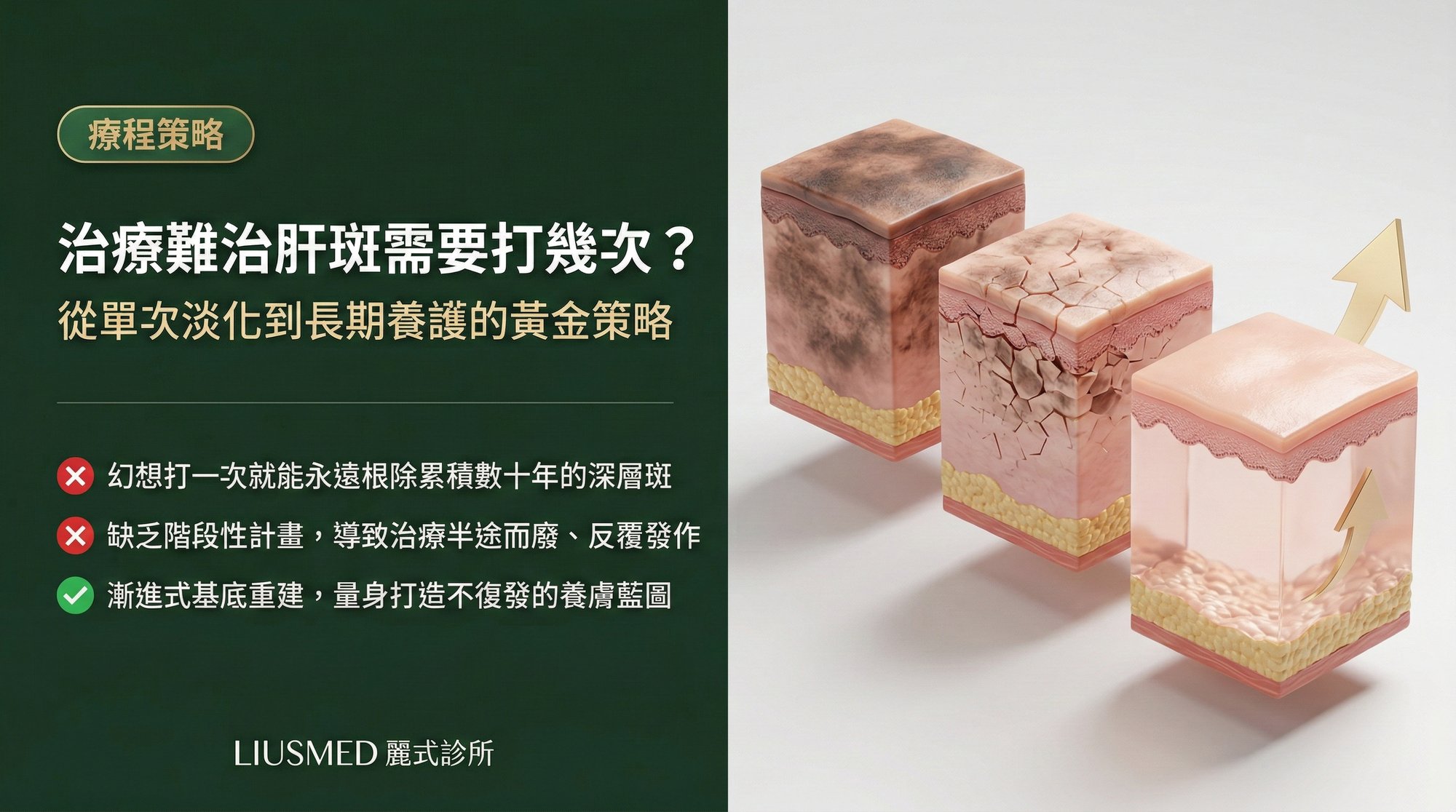 治療難治性肝斑需要打幾次「肝斑針」?從單次淡化到長期養護的黃金策略