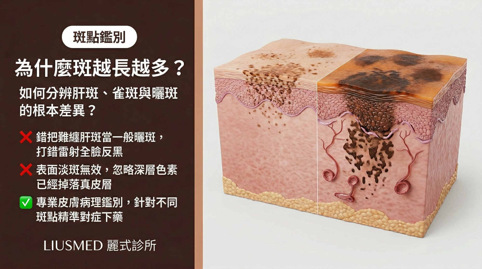 為什麼斑越長越多?如何分辨肝斑、雀斑與曬斑的根本差異?