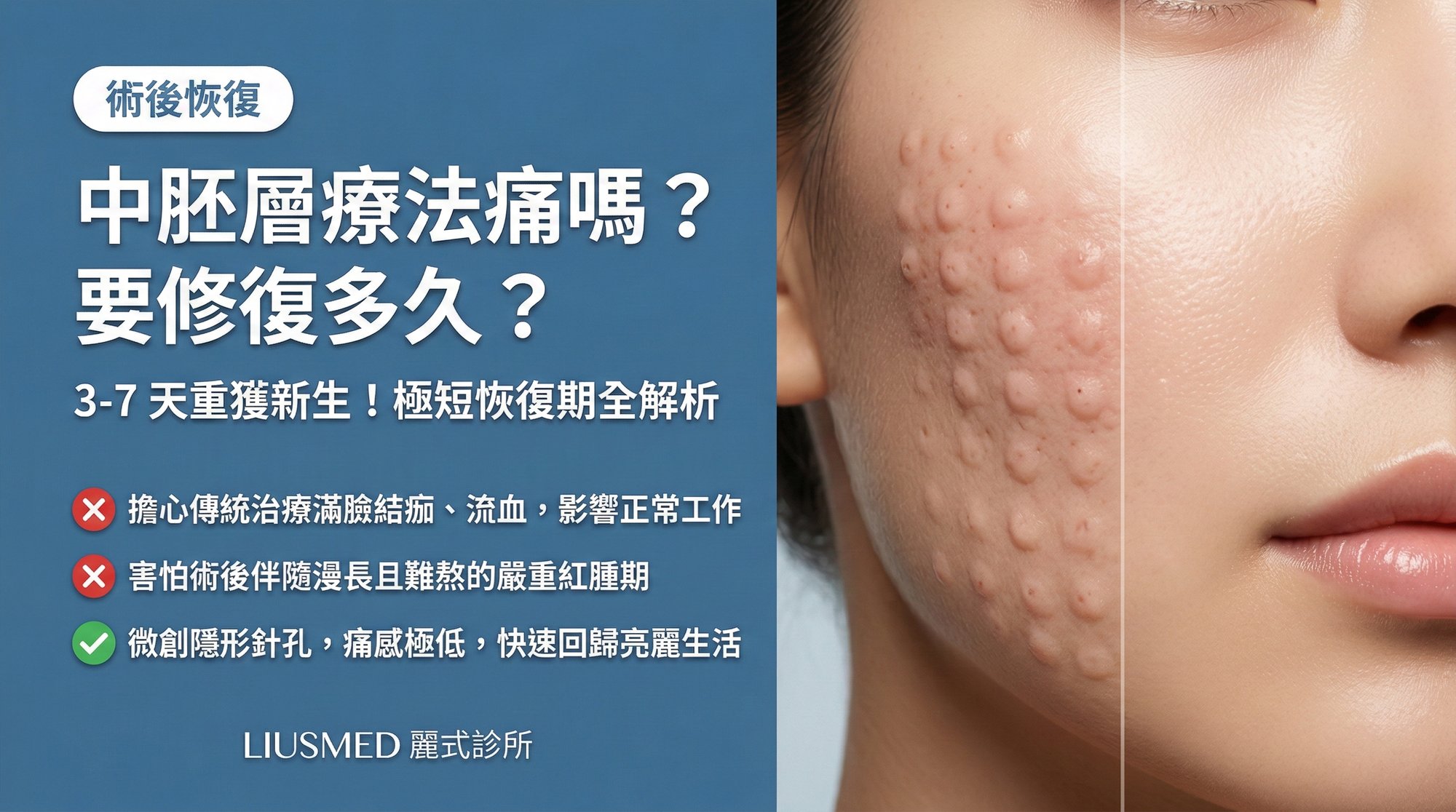 麗式中胚層療法(手打水光針) (Mesotherapy) 痛嗎?恢復期要多久?3-7 天重獲新生全解析
