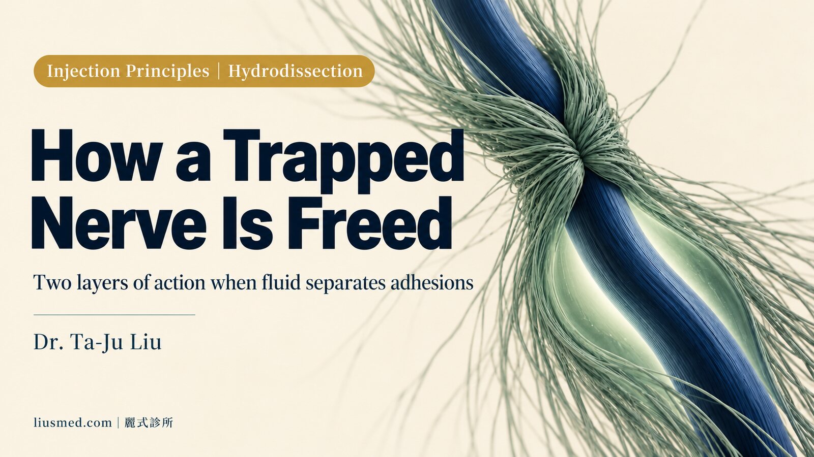 How Nerve Hydrodissection Works: Freeing a Trapped Nerve Under Ultrasound Guidance