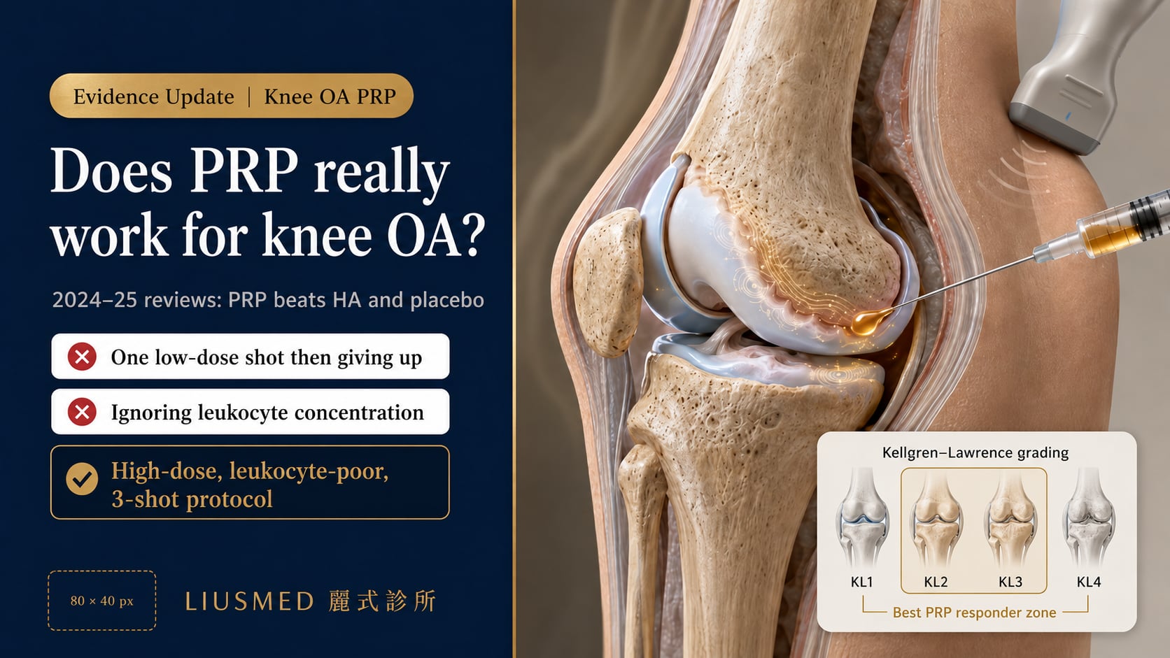 PRP for Knee Osteoarthritis — 2026 Evidence Update: Systematic Reviews, Dosage, and Clinical Recommendations