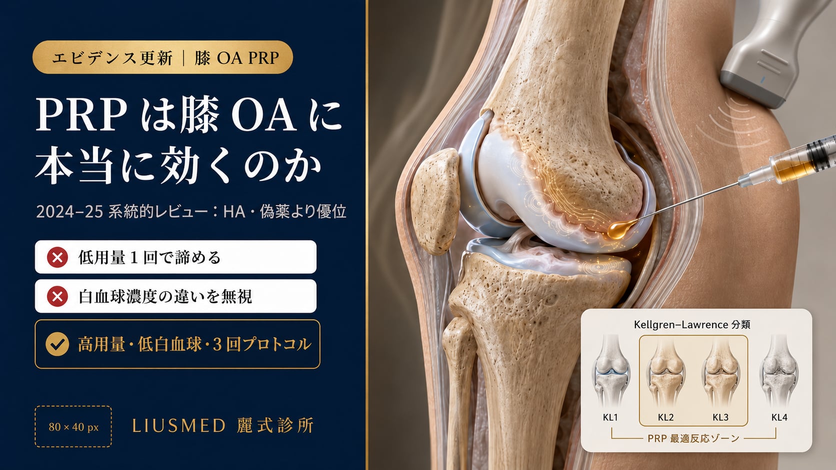 変形性膝関節症 PRP 治療エビデンス 2026 アップデート：系統的レビュー・用量比較・臨床推奨