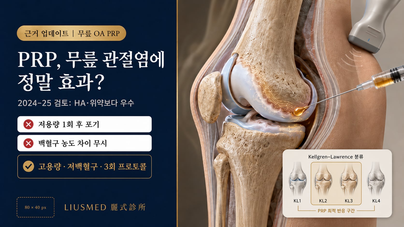 퇴행성 무릎 관절염 PRP 치료 근거 2026 업데이트: 체계적 검토, 용량 비교 및 임상 권장 사항