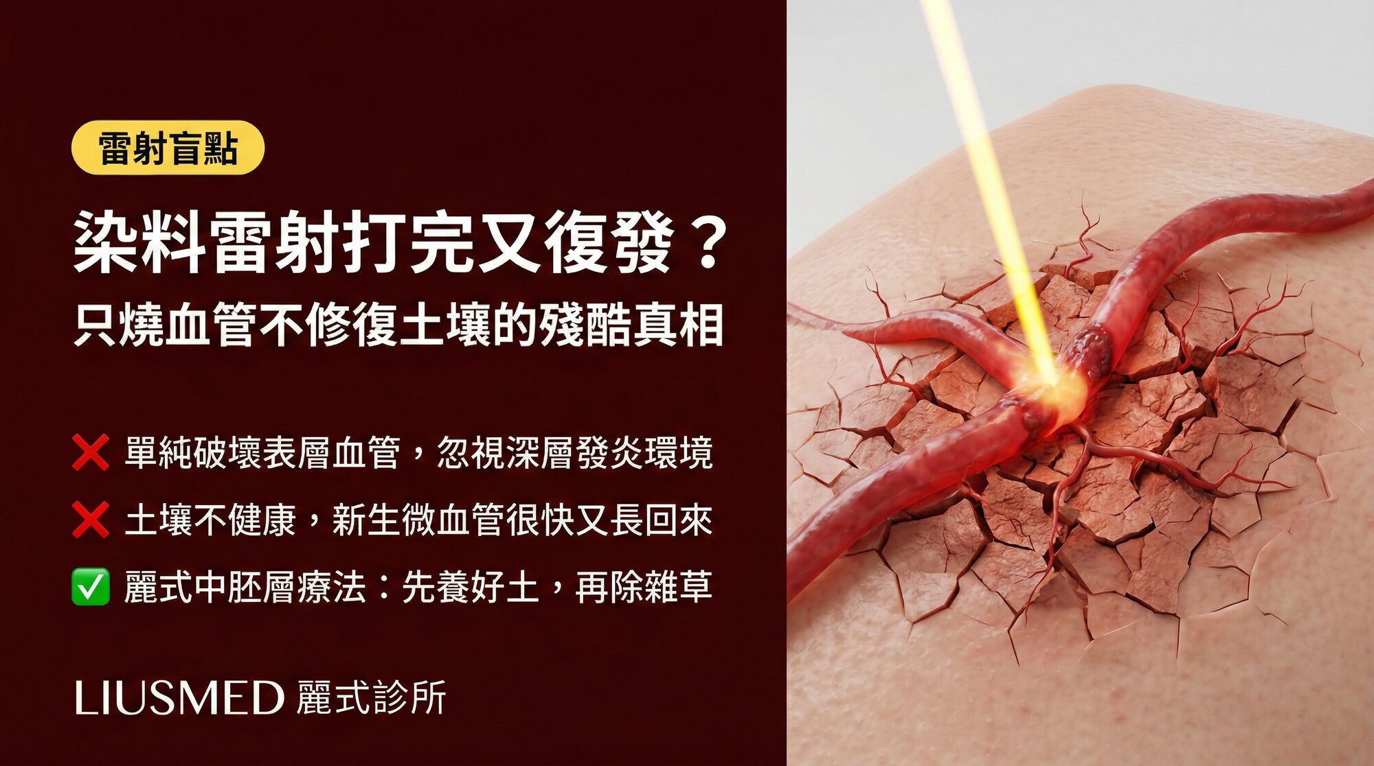 為什麼染料雷射打完一個月又復發?只燒血管不修復土壤的殘酷真相