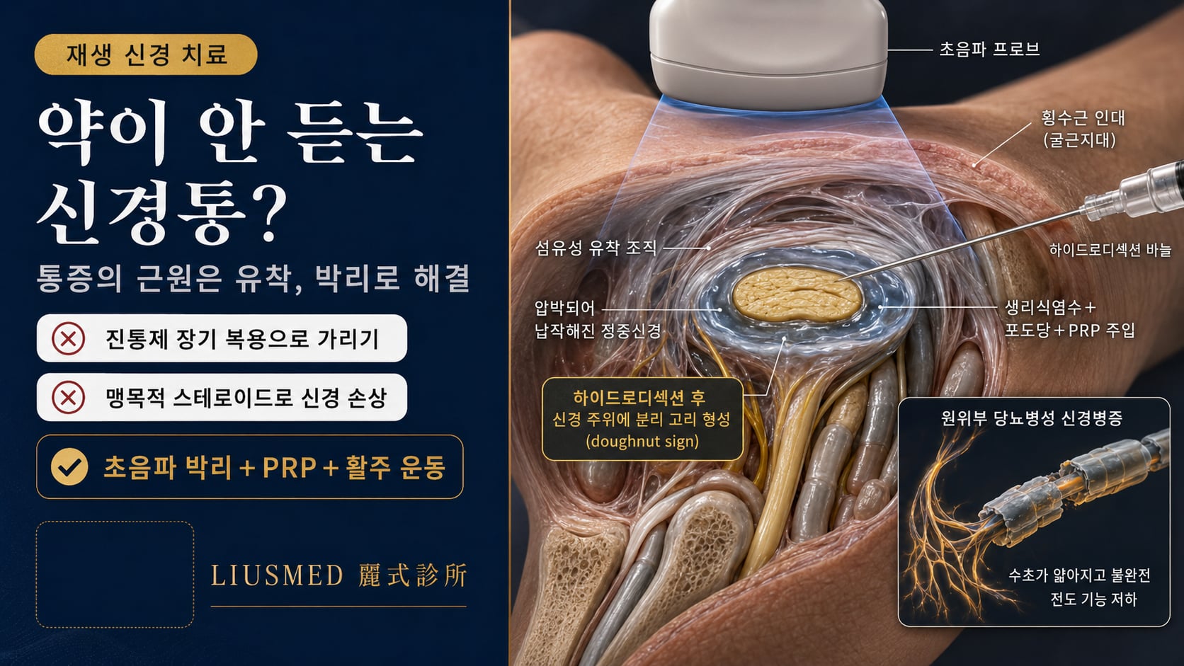 말초 신경병증의 재생 의학 선택지: 초음파 유도 신경 박리·PRP·신경 활주 완벽 해설(2026 근거)