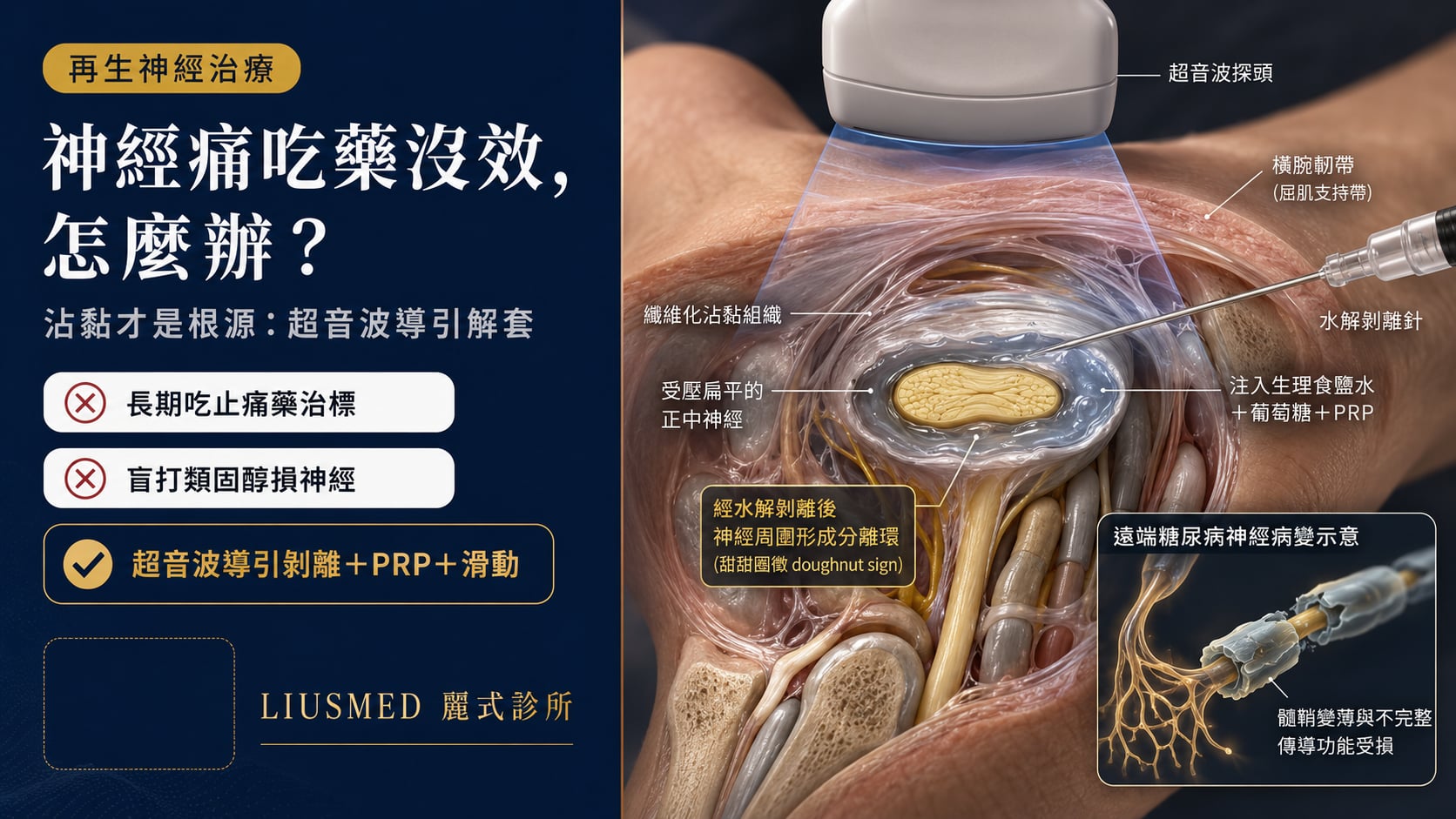 周邊神經病變的再生醫學選項：超音波導引神經剝離、PRP、神經滑動全解析（2026 實證）