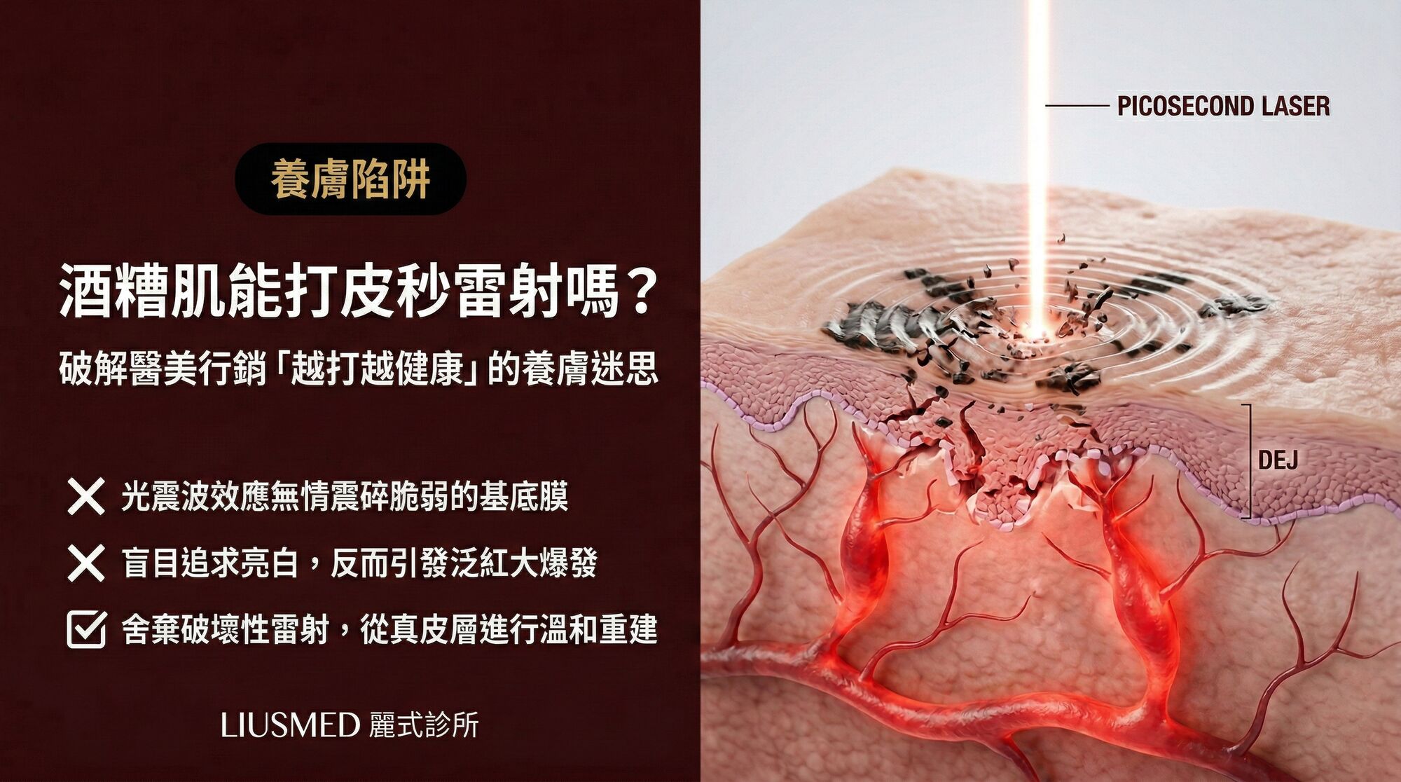 酒糟肌到底能不能打皮秒雷射?破解醫美行銷的「養膚雷射」迷思