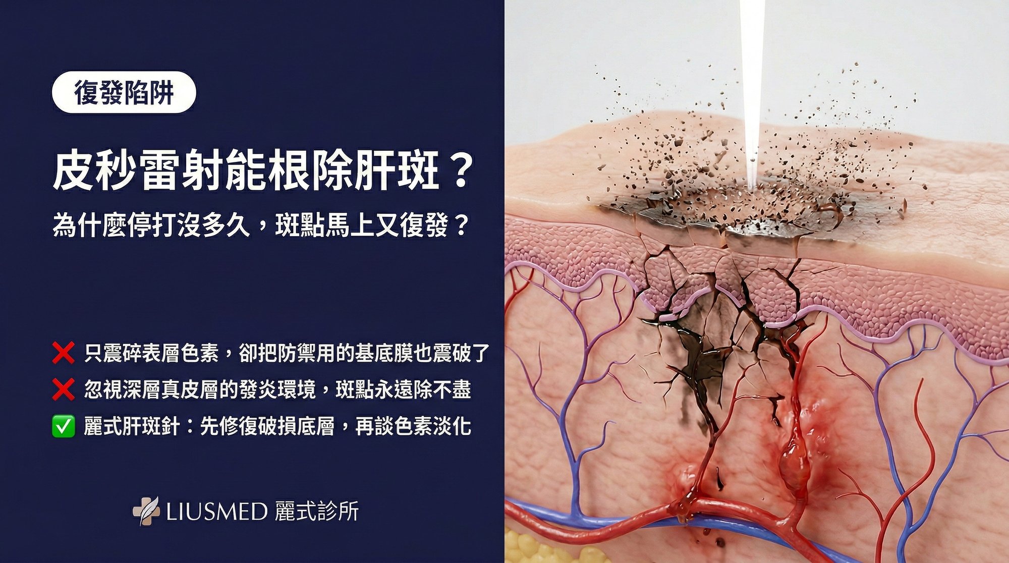 皮秒雷射真的能根除肝斑嗎?為什麼停打後沒多久又復發?