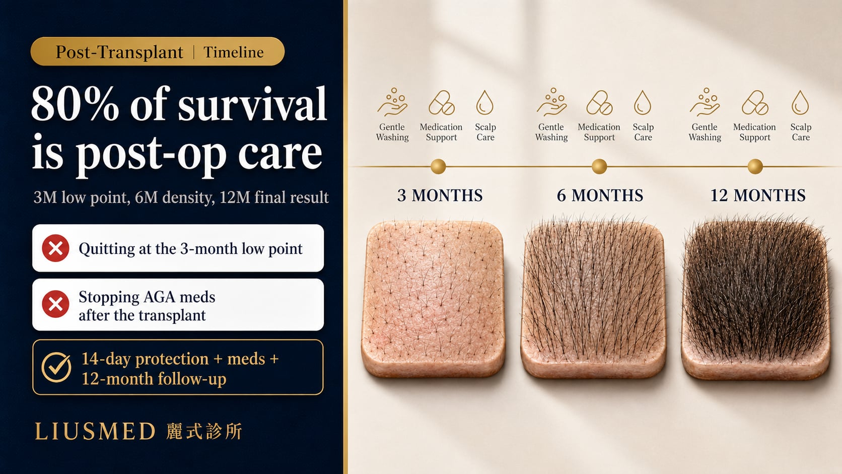 Post Hair Transplant Maintenance: 3 / 6 / 12-Month Complete Checklist (2026 Evidence-Based)