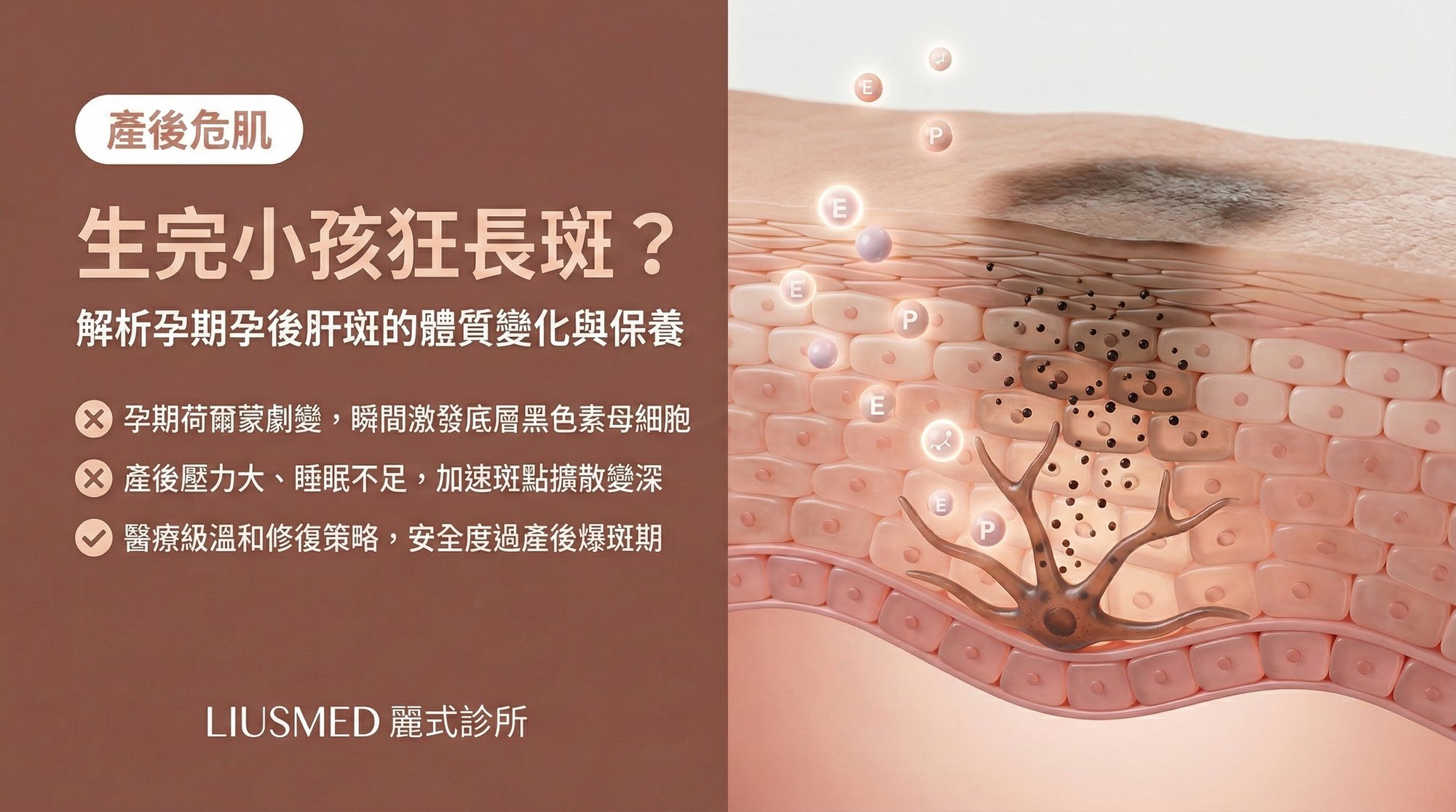 為什麼生完小孩後狂長斑?孕期孕後肝斑的體質變化與初期保養