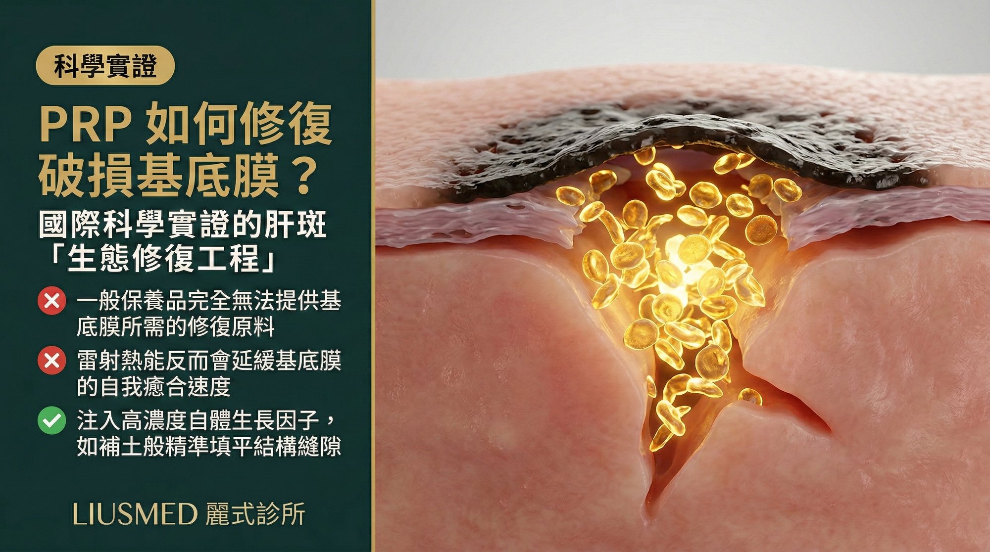 高濃度 PRP 如何修復破損基底膜?科學實證的肝斑「生態修復工程」
