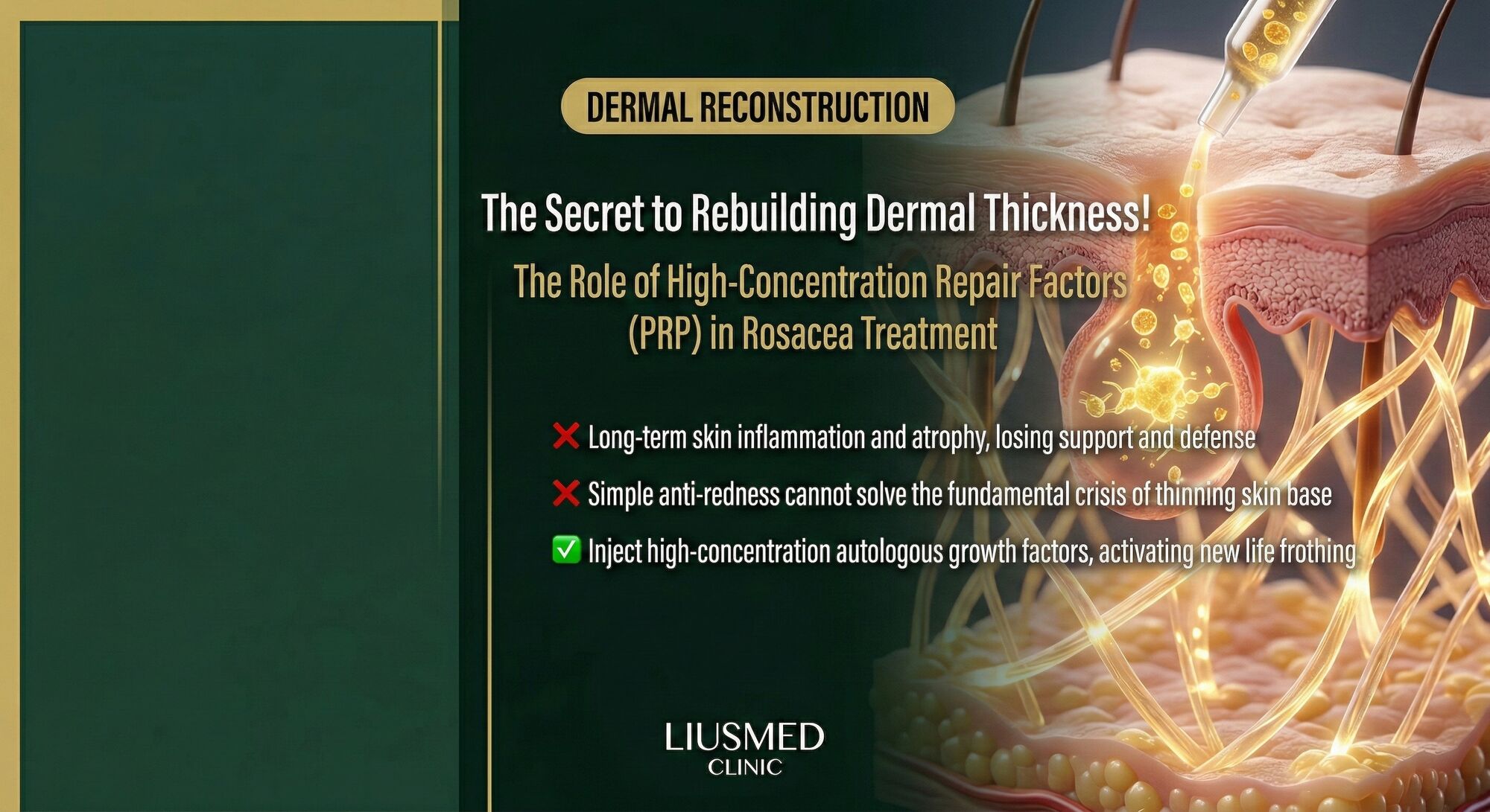 The Role of PRP/PLT Growth Factors in Rosacea Treatment: Rebuilding Dermal Thickness