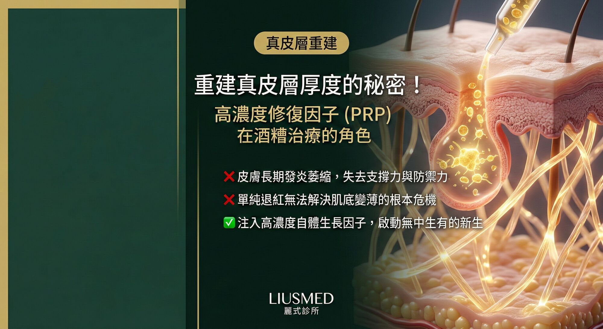 高濃度修復因子 (PRP/PLT) 在酒糟治療的角色:重建真皮層厚度的秘密