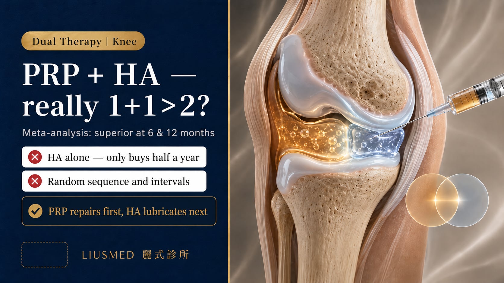 PRP + Hyaluronic Acid (HA) Combined Knee Injection: Evidence, Mechanism, and Optimal Protocol Design (2026 Guide)